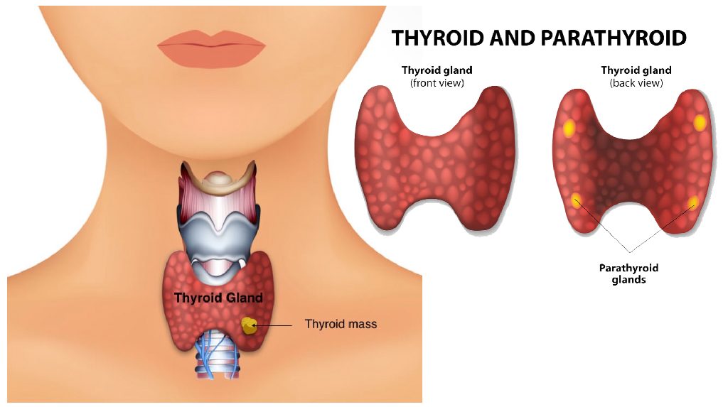 Thyroid Disorders Diagram